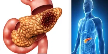 പാന്‍ക്രിയാസില്‍ അര്‍ബുദം ബാധിച്ചതിന്‍റെ ചിത്രം (ഇടത്ത്)പാന്‍ക്രിയാസ് ശരീരത്തില്‍ എവിടെയെന്ന് കാണിക്കുന്ന ചിത്രം (വലത്ത്)