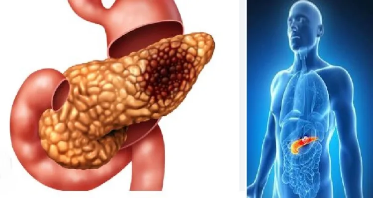 പാന്‍ക്രിയാസില്‍ അര്‍ബുദം ബാധിച്ചതിന്‍റെ ചിത്രം (ഇടത്ത്)പാന്‍ക്രിയാസ് ശരീരത്തില്‍ എവിടെയെന്ന് കാണിക്കുന്ന ചിത്രം (വലത്ത്)