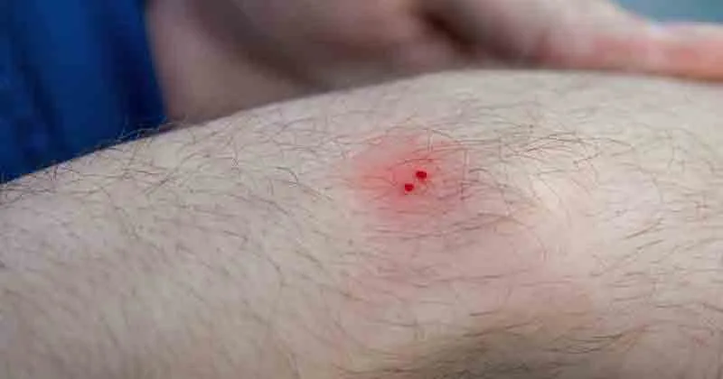 പാമ്പുകടി: പ്രതിരോധവും ചികിത്സയും വളരെ പ്രധാനം, സമയബന്ധിതമായ ചികിത്സ ഉറപ്പാക്കണം